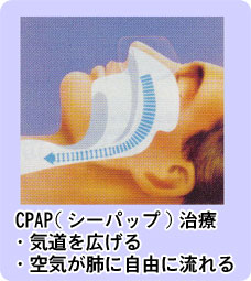 cpap治療
